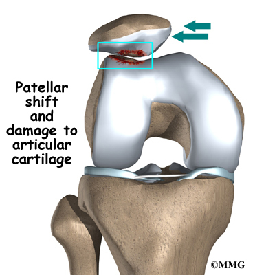 Damaged Cartilage Under Kneecap Symptoms